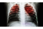 Akciğer Tüberkülozu