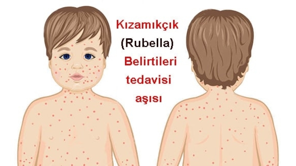 Kızamıkçık